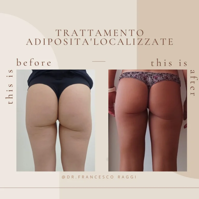 intralipoterapia con vitamina c