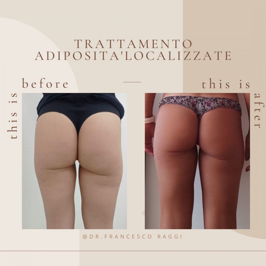 intralipoterapia con vitamina c