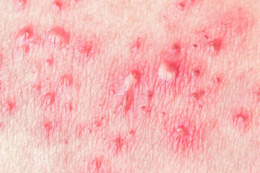 Herpes zooster