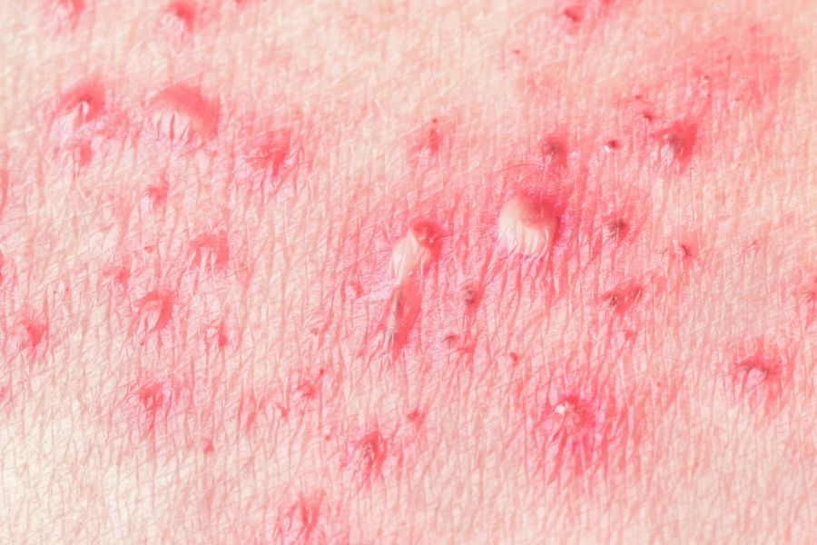 Herpes zooster
