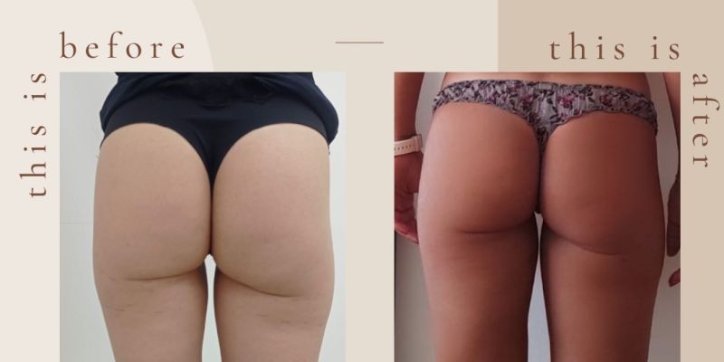intralipoterapia con vitamina c